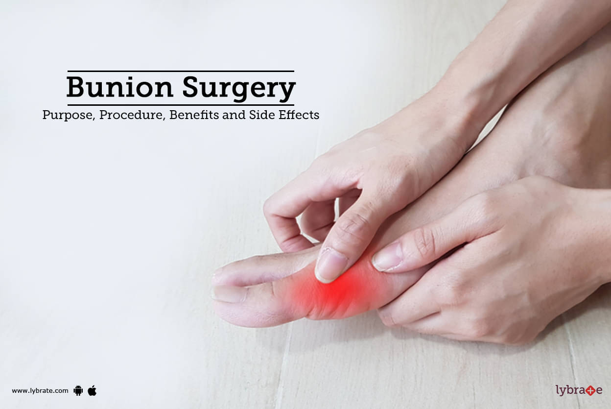 Bunion Surgery Purpose Procedure Benefits And Side Effects