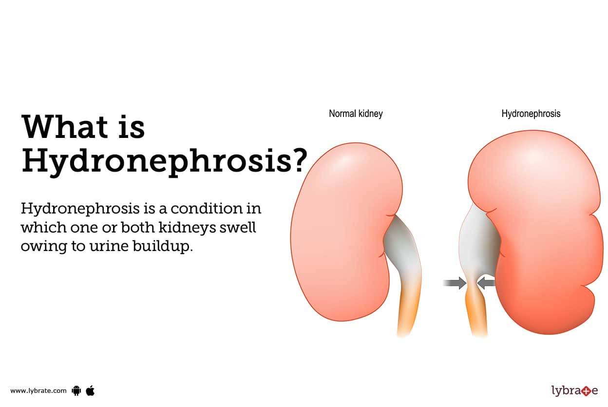 Hydronephrosis: Causes, Symptoms, Treatment and Cost