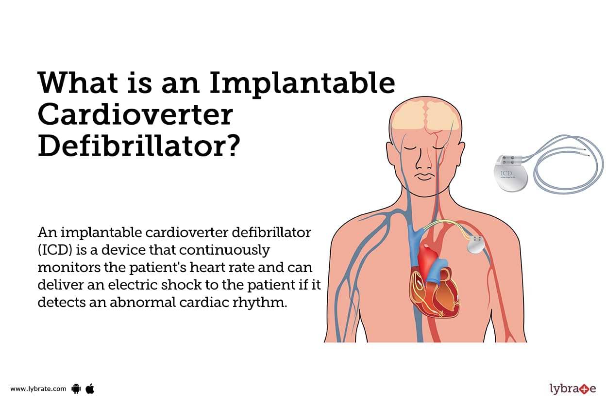 Implantable Cardioverter Defibrillator Causes, Symptoms, Treatment and Cost