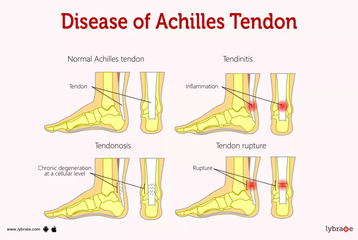 Do have Achilles pain? Let us help you!