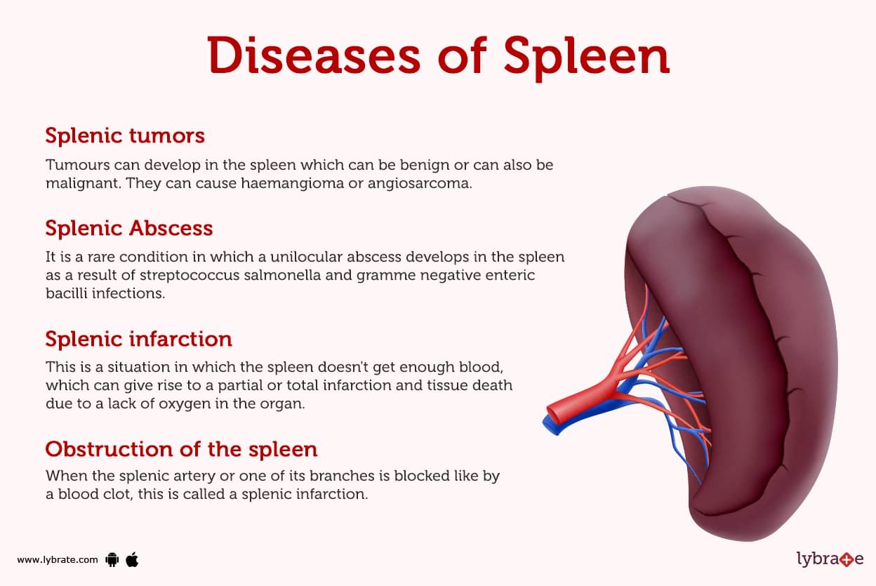 Enlarged Spleen (Splenomegaly): Symptoms, Causes Treatment, 55% OFF