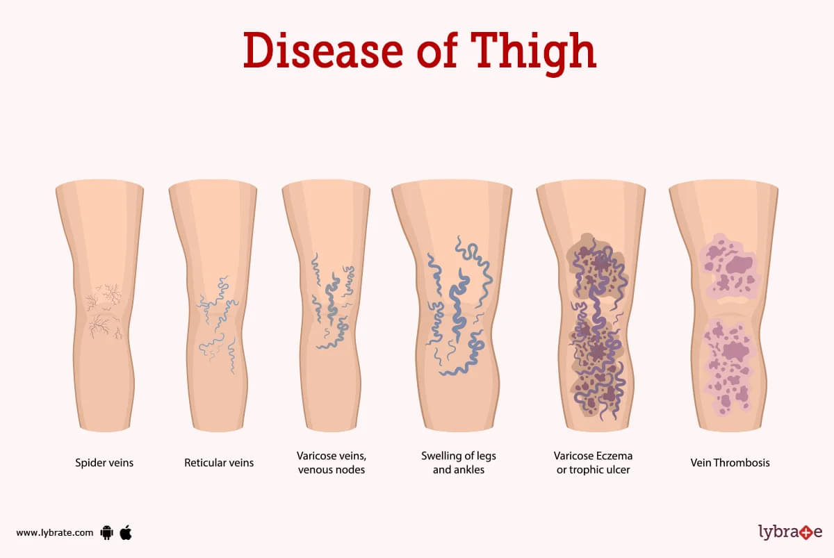 Thigh (Human Anatomy): Image, Function, Diseases, and Treatments