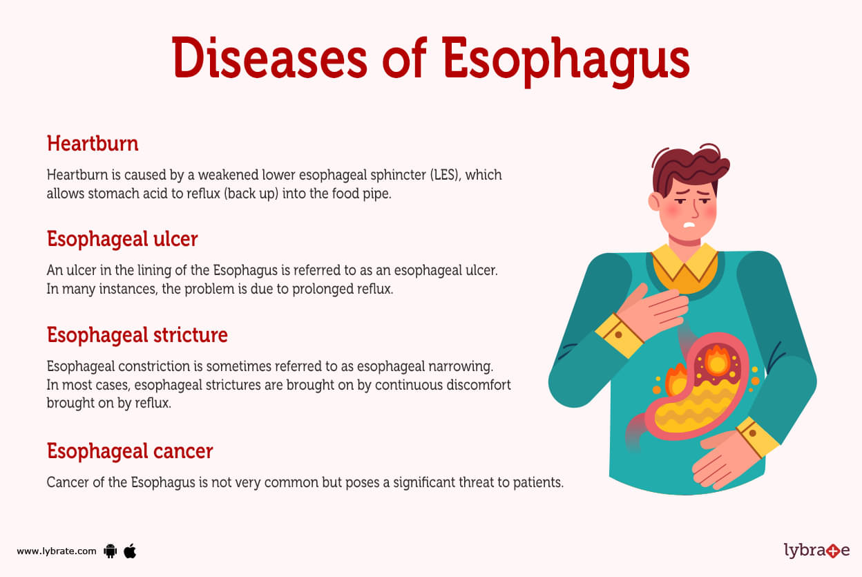 PATHOLOGY OF THE ESOPHAGUS - ppt video online download