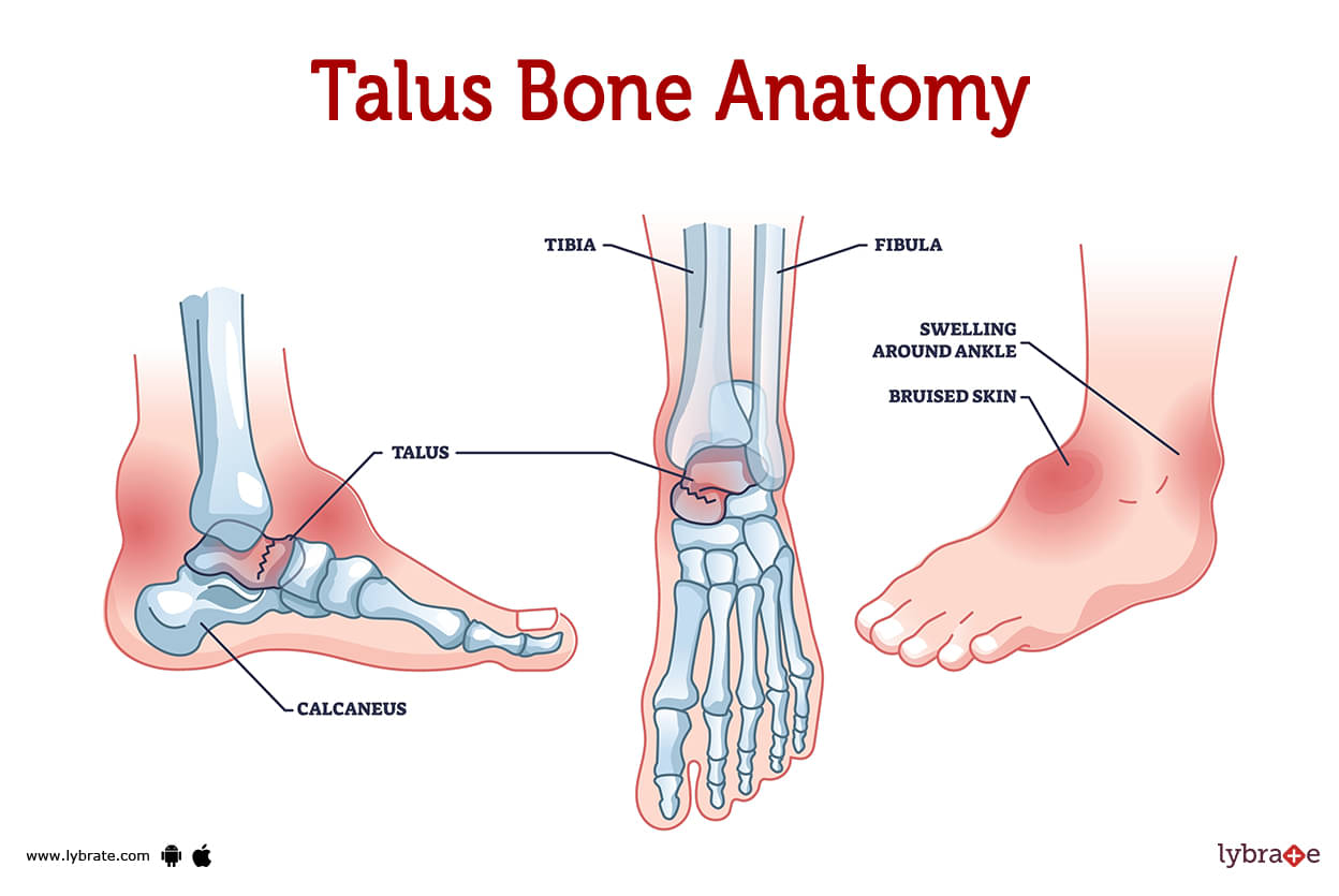 talus bone fracture recovery time
