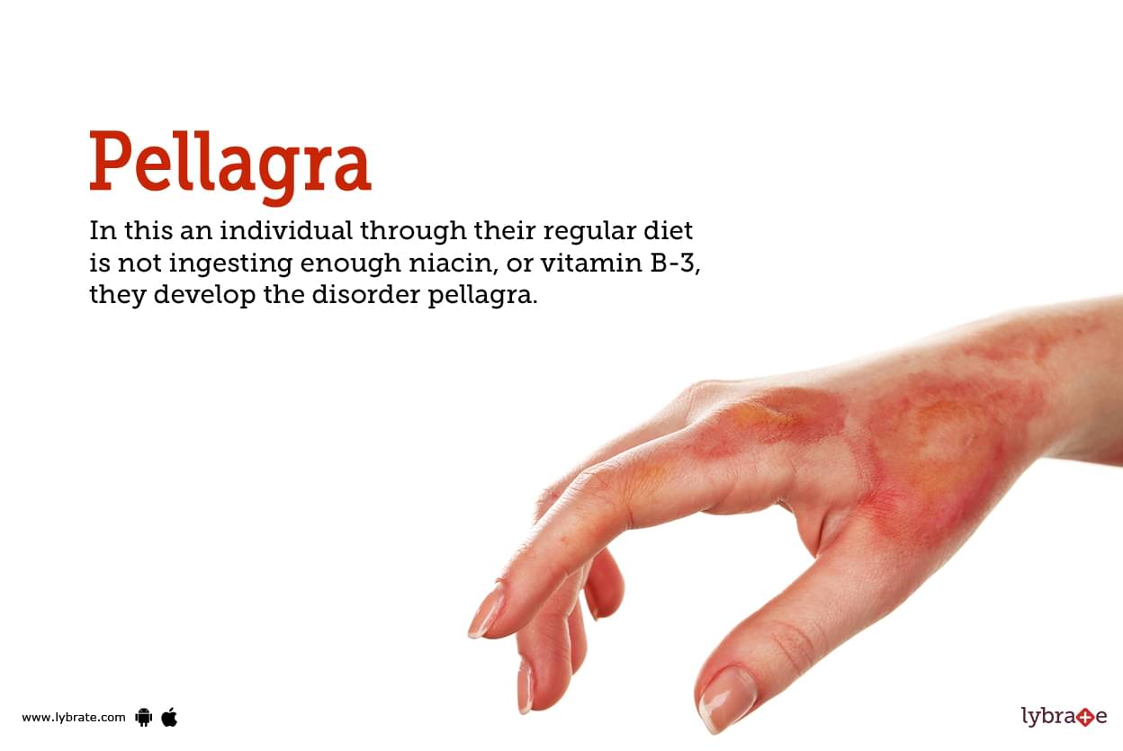 pellagra hands