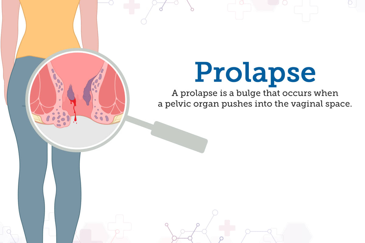 Causes of uterine prolapse