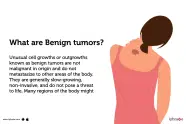 Benign Tumors Causes Symptoms Treatment And Cost