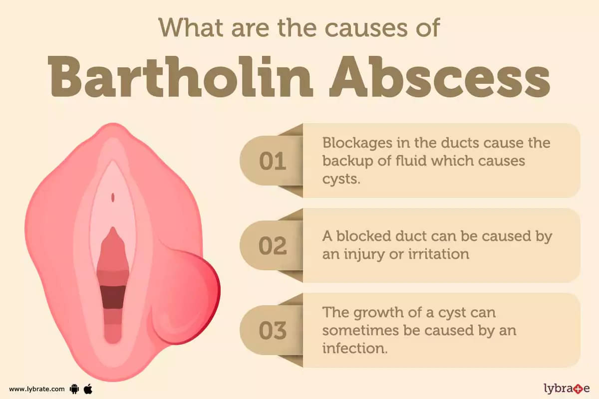 Bartholin Cyst: What Is It, Causes, and More