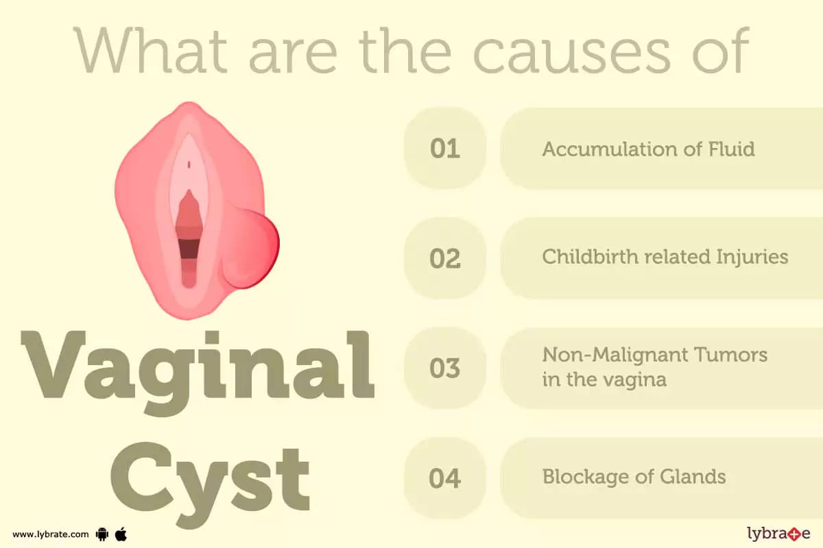 Vaginal Cysts: Types, Symptoms, Causes, and Treatment