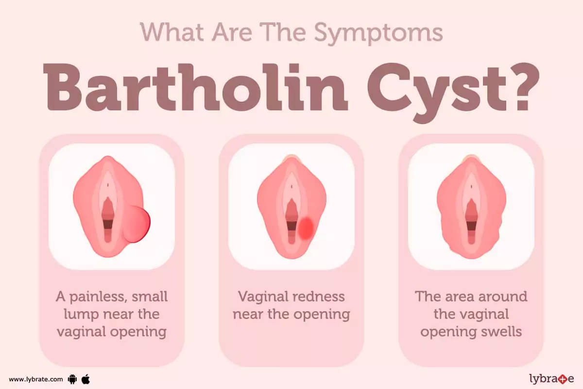 Bartholin's Cyst : Causes, Symptoms and Treatment - Ayurveda for