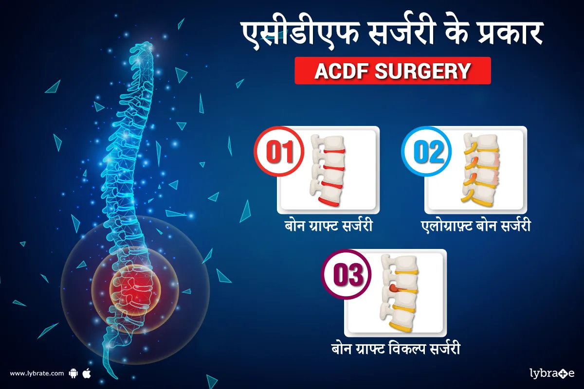 एसीडीएफ सर्जरी के प्रकार - ACDF surgery ke prakar