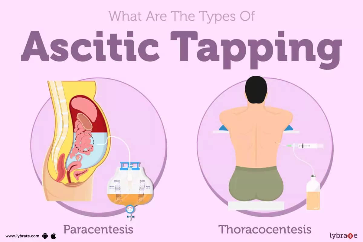Ascitic Tapping: Causes, Symptoms, Treatment and Cost