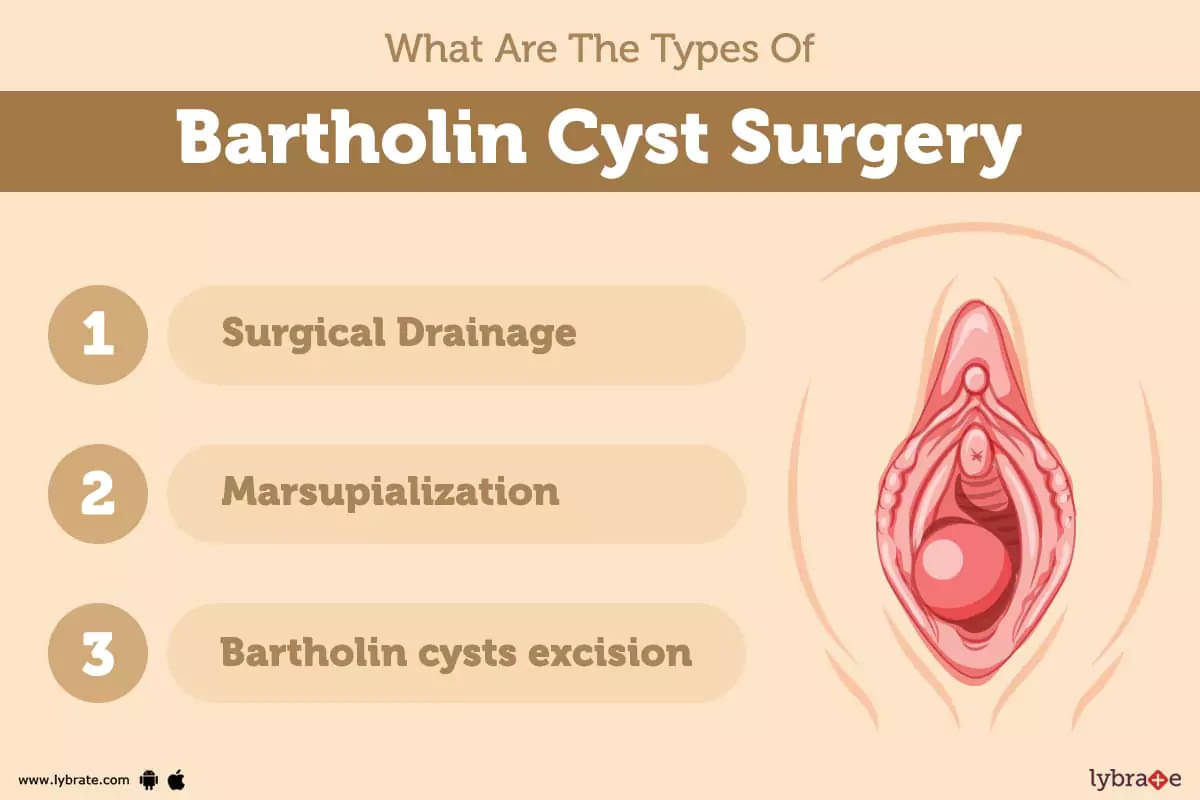 Learn about Bartholin's gland cyst removal technique