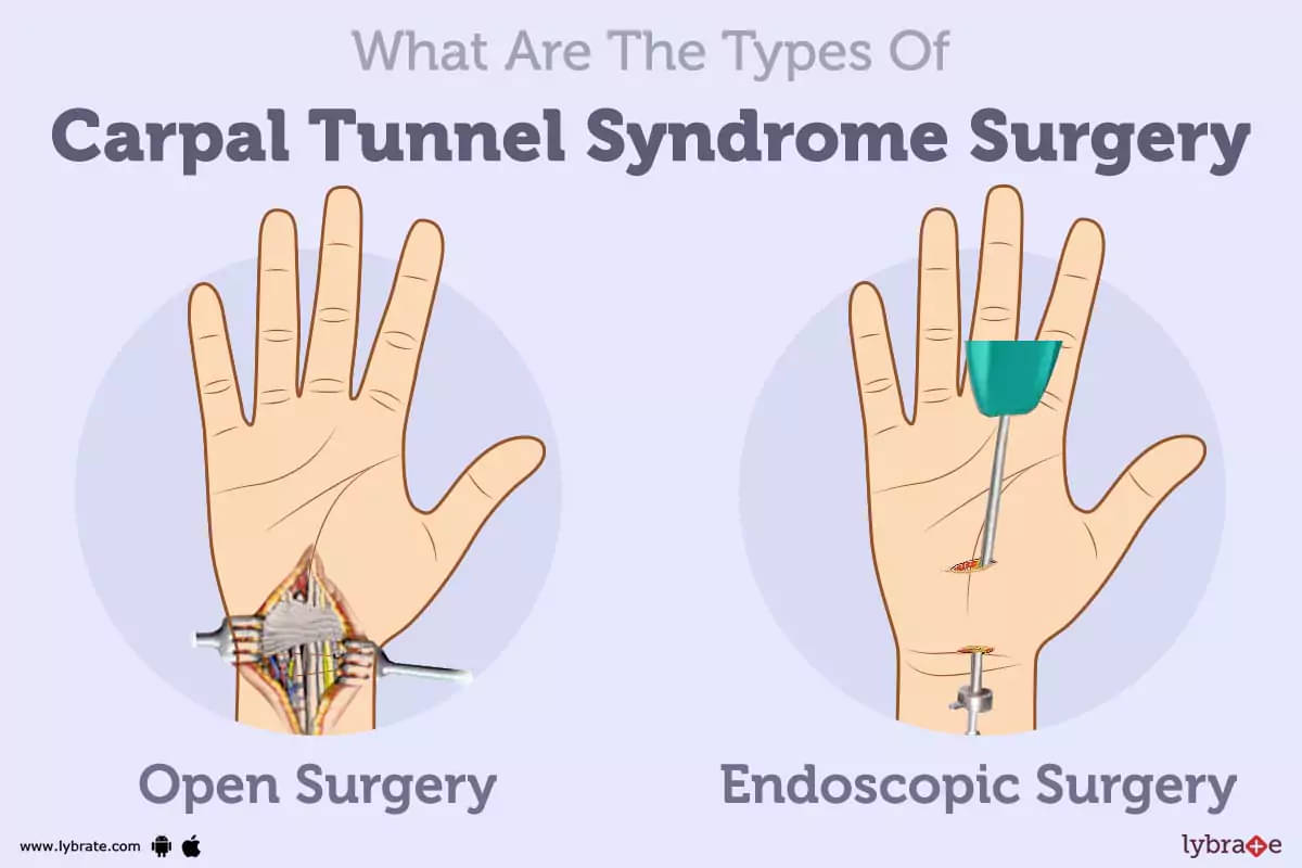 Carpal Tunnel Syndrome Surgery: Purpose, Procedure, Benefits and Side  Effects