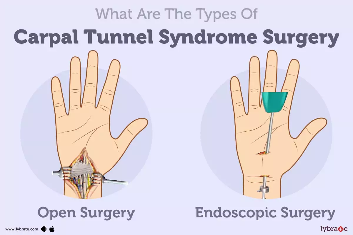 Types Of Carpal Tunnel Surgery Types Of Carpal Tunnel Surgery