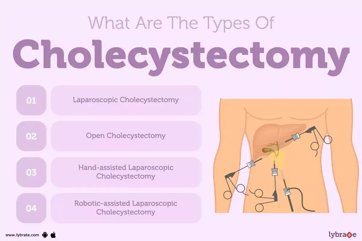 open-cholecystectomy-causes-symptoms-treatment-and-cost