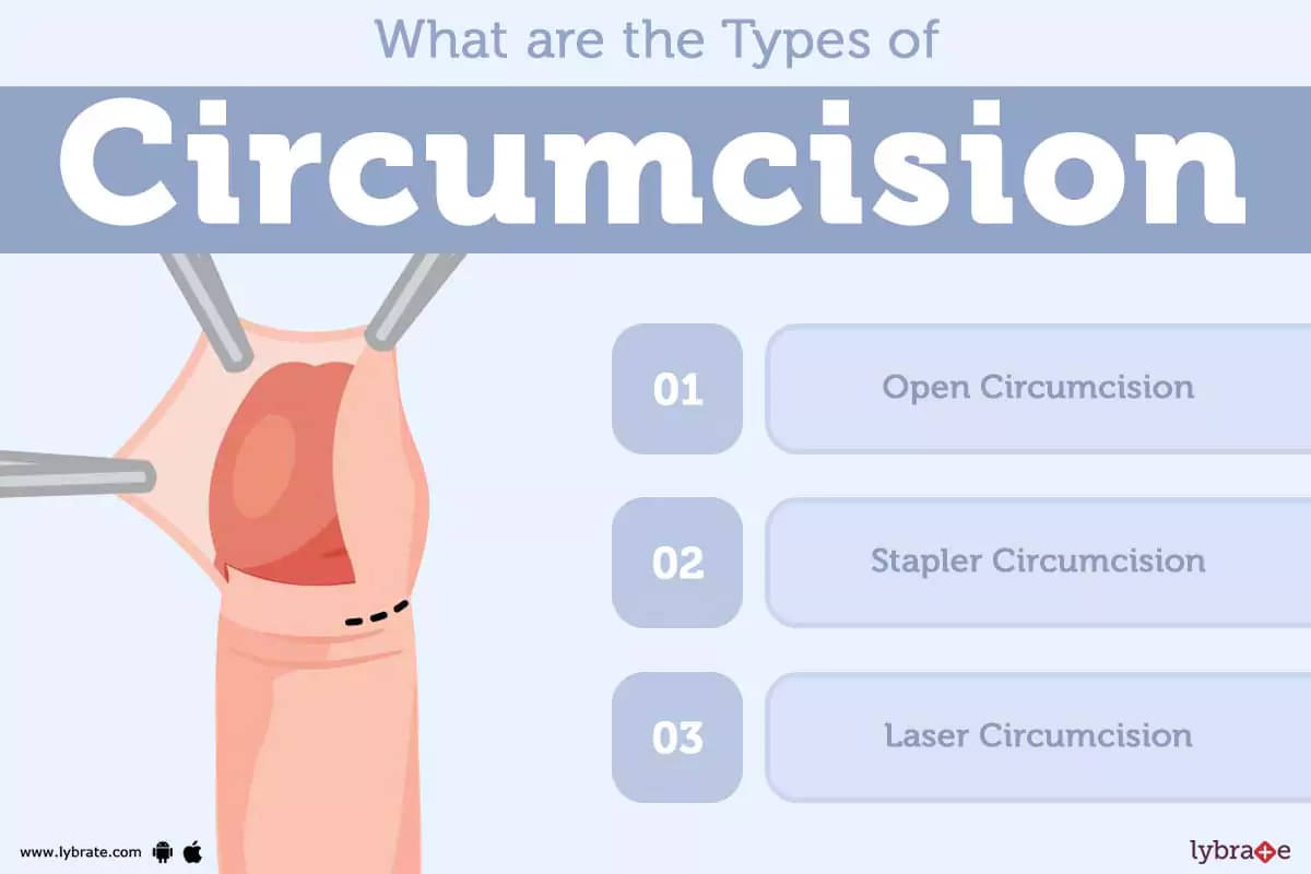 Circumplast Circumcision at Circumcision Centre, Bedfordshire & London, UK  - YouTube