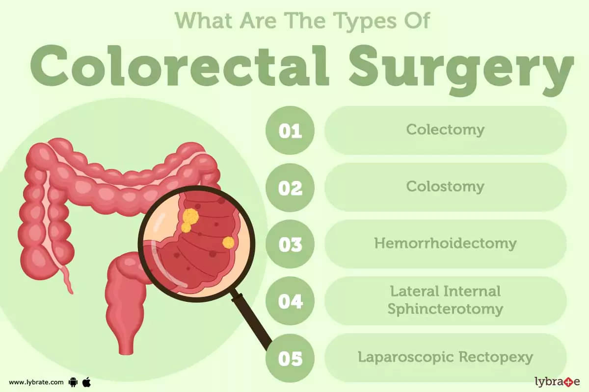 Colorectal Surgery Purpose Procedure And Benefits And Side Effects