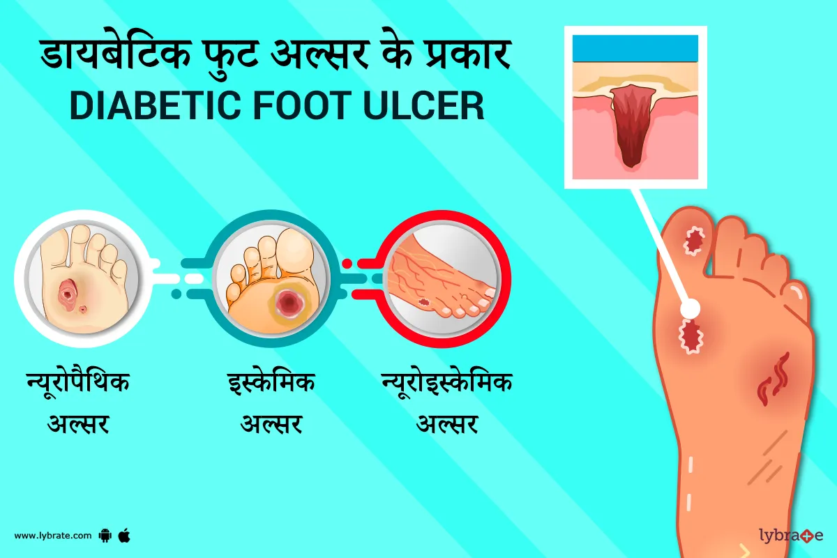 डायबेटिक फुट अल्सर के प्रकार (Diabetic Foot Ulcer Ke Prakaar)