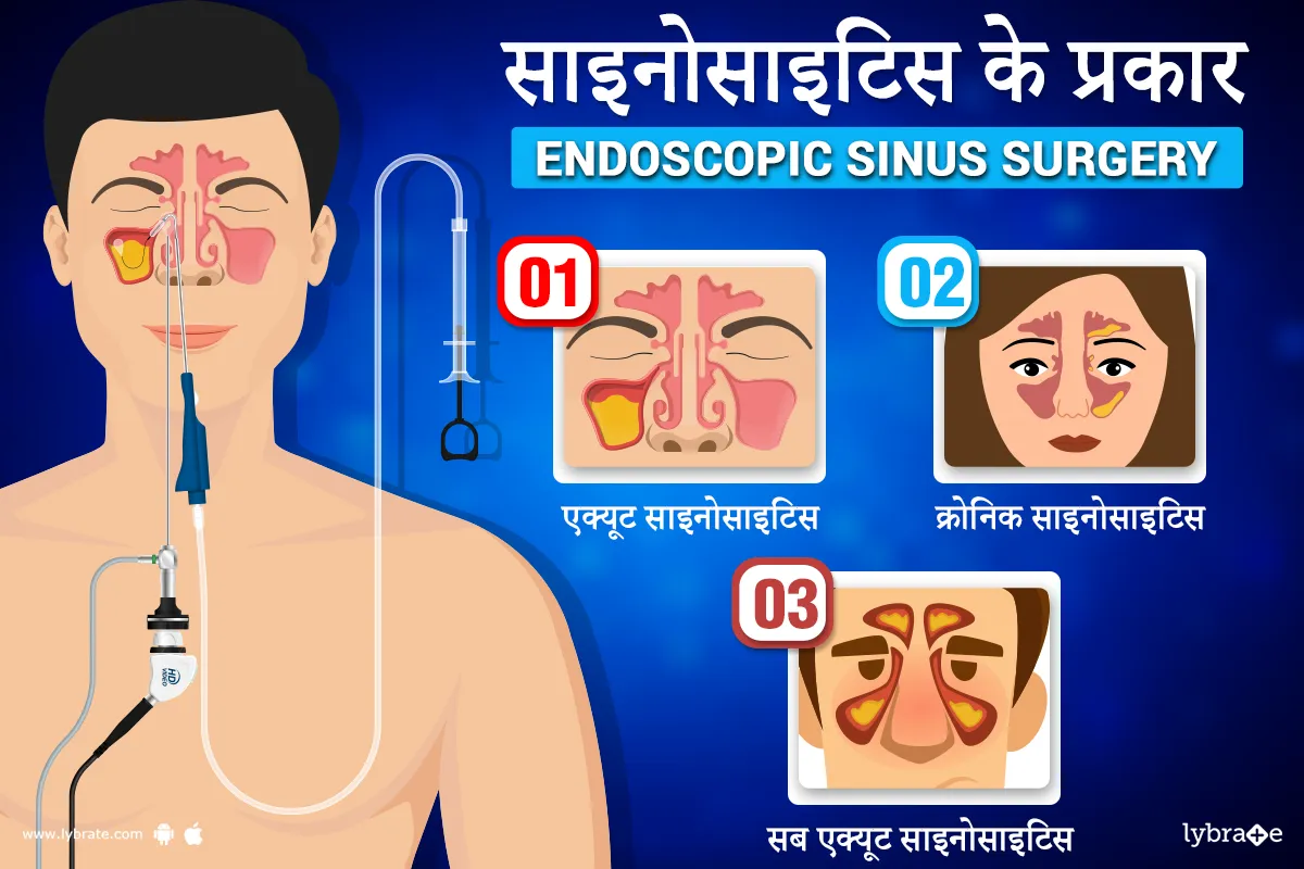 साइनोसाइटिस के प्रकार
