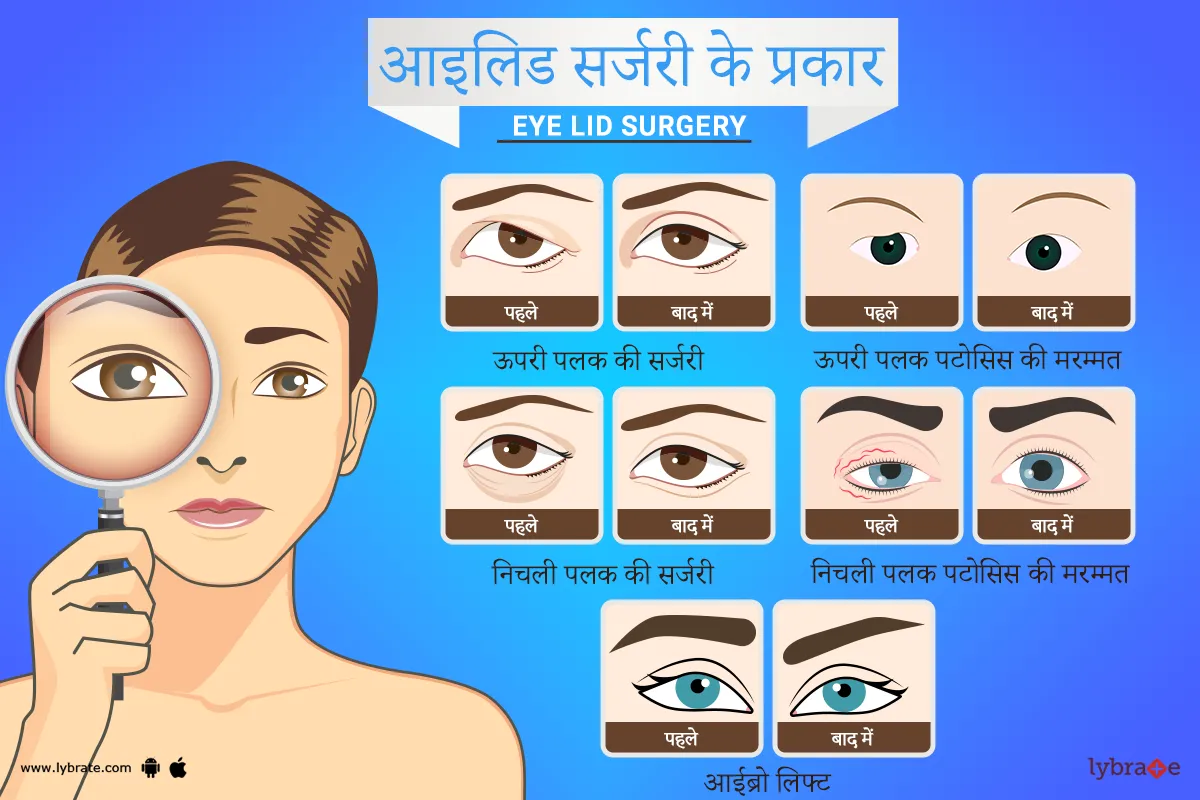 आइलिड सर्जरी के प्रकार - eyelid surgery ke prakar