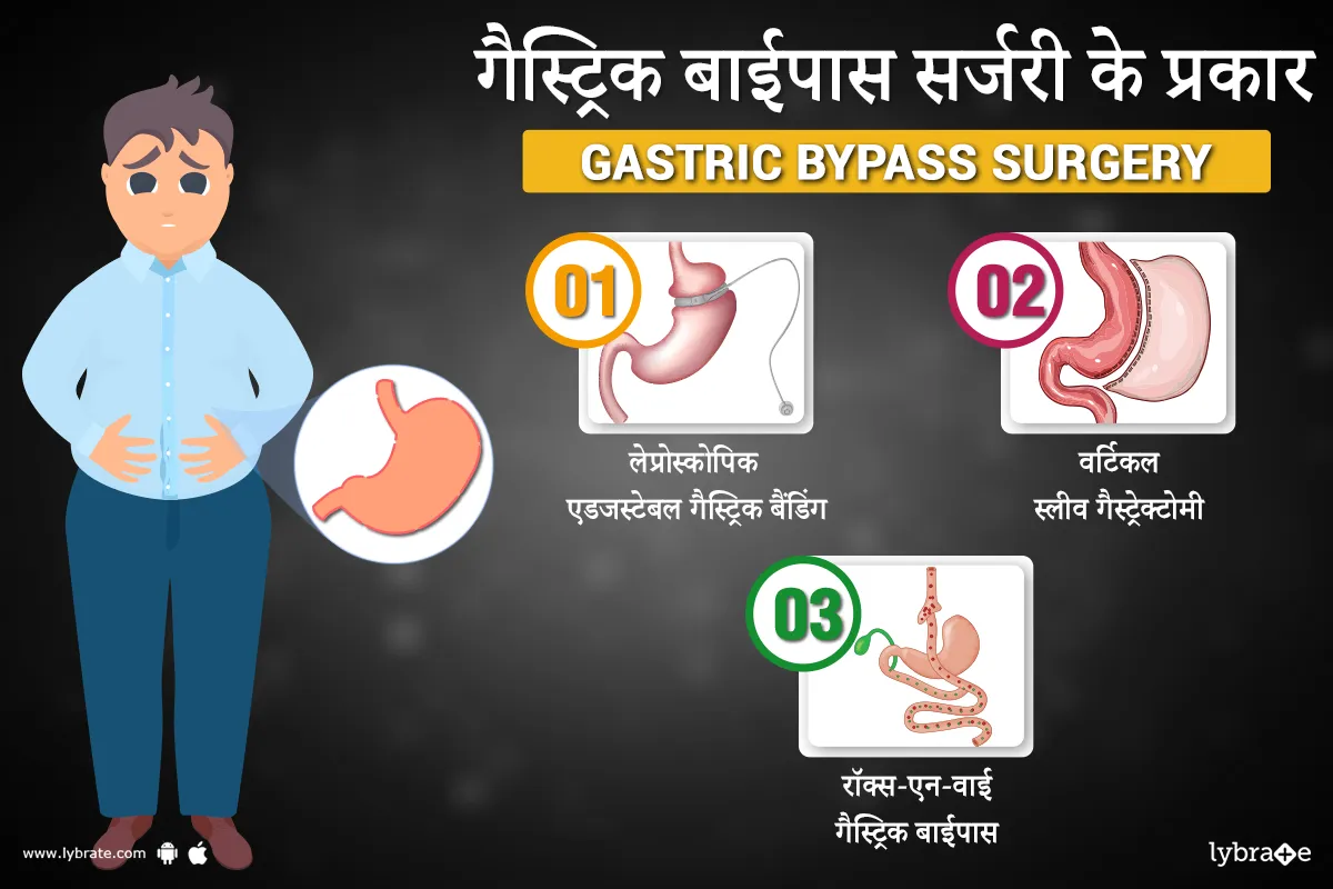गैस्ट्रिक बाईपास सर्जरी के प्रकार - Gastric bypass surgery ke prakar