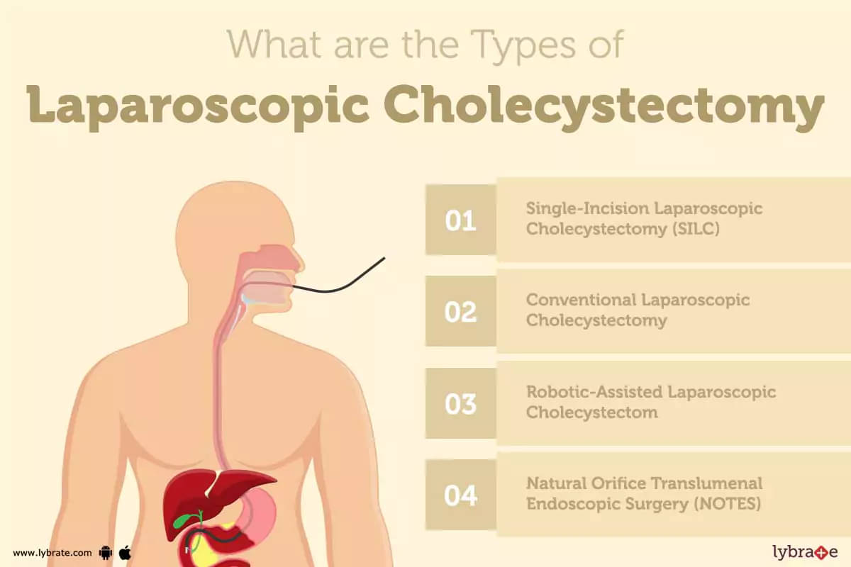 Cholecystectomy: Everything you need to know before the procedure