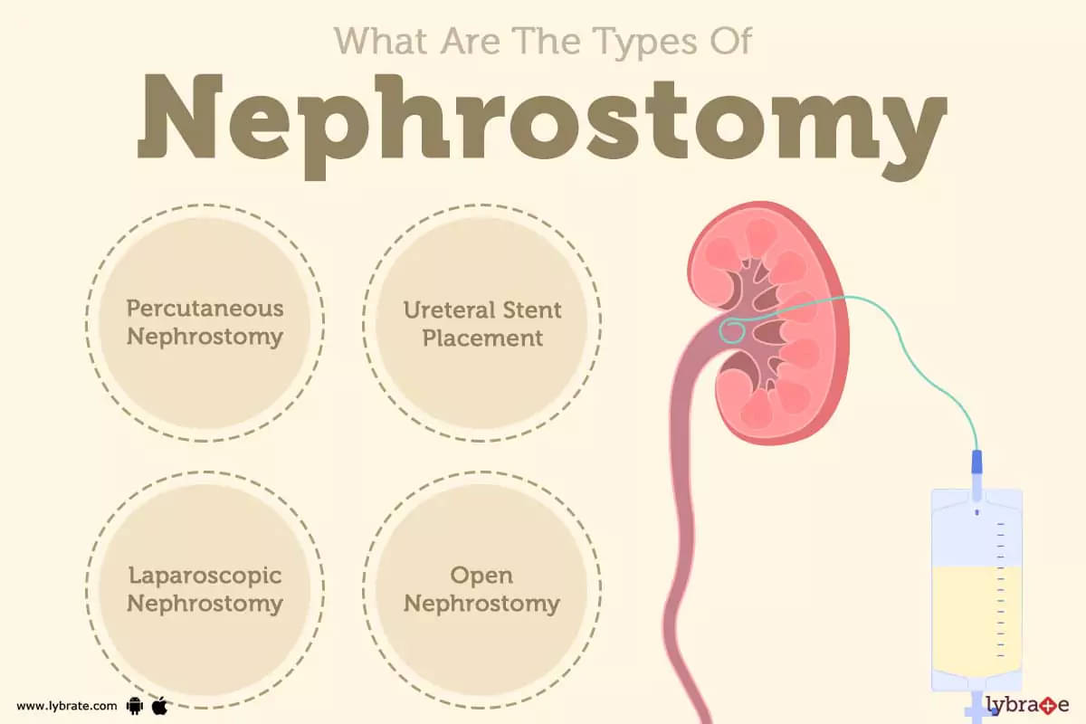 nephrostomy tube
