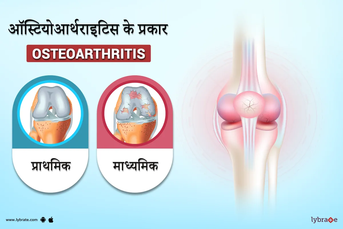 ऑस्टियोआर्थराइटिस के प्रकार | Types of Osteoarthritis