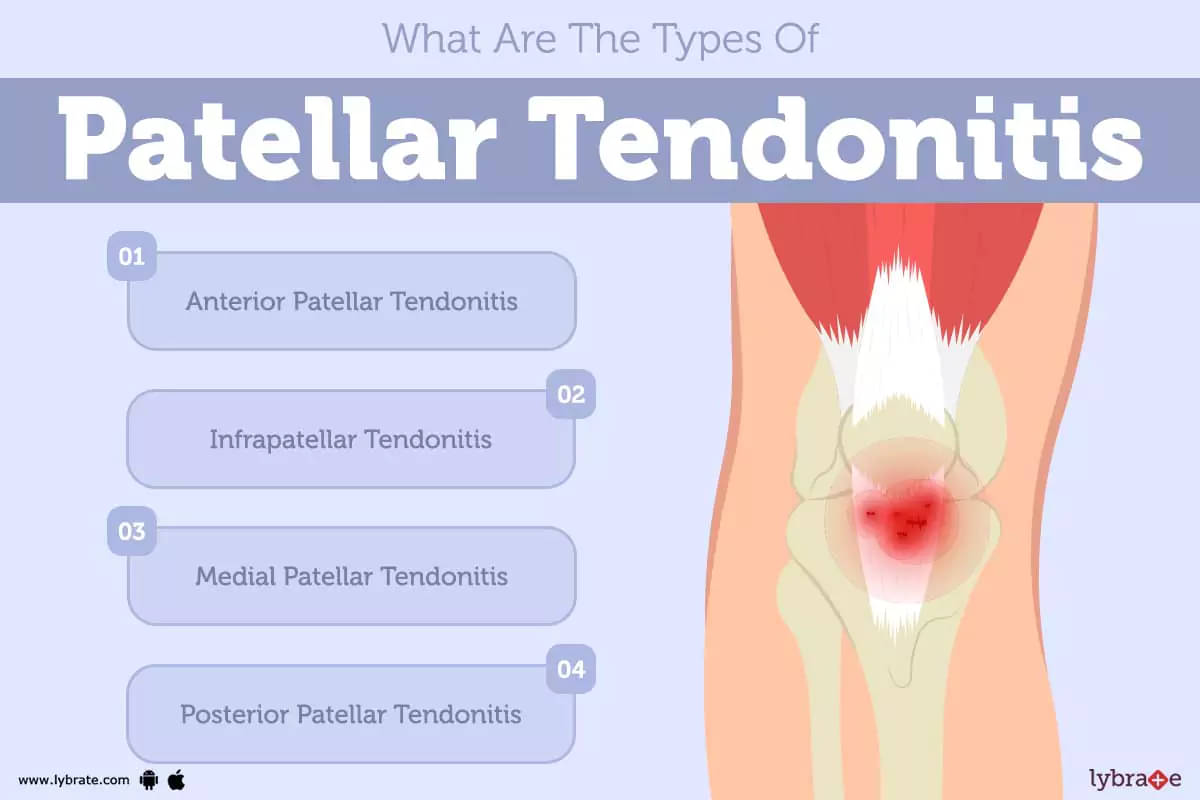 Patellar Tendonitis: Causes, Symptoms, Treatment and Cost