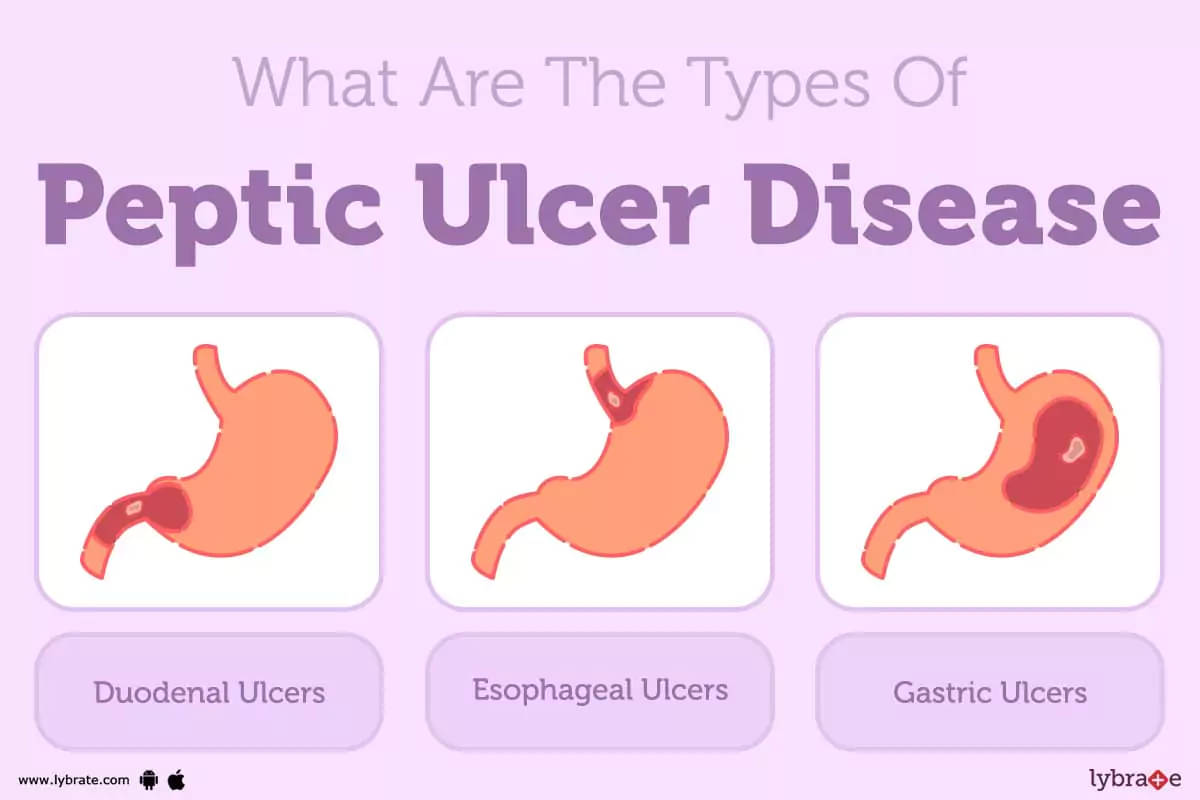 gastric ulcer