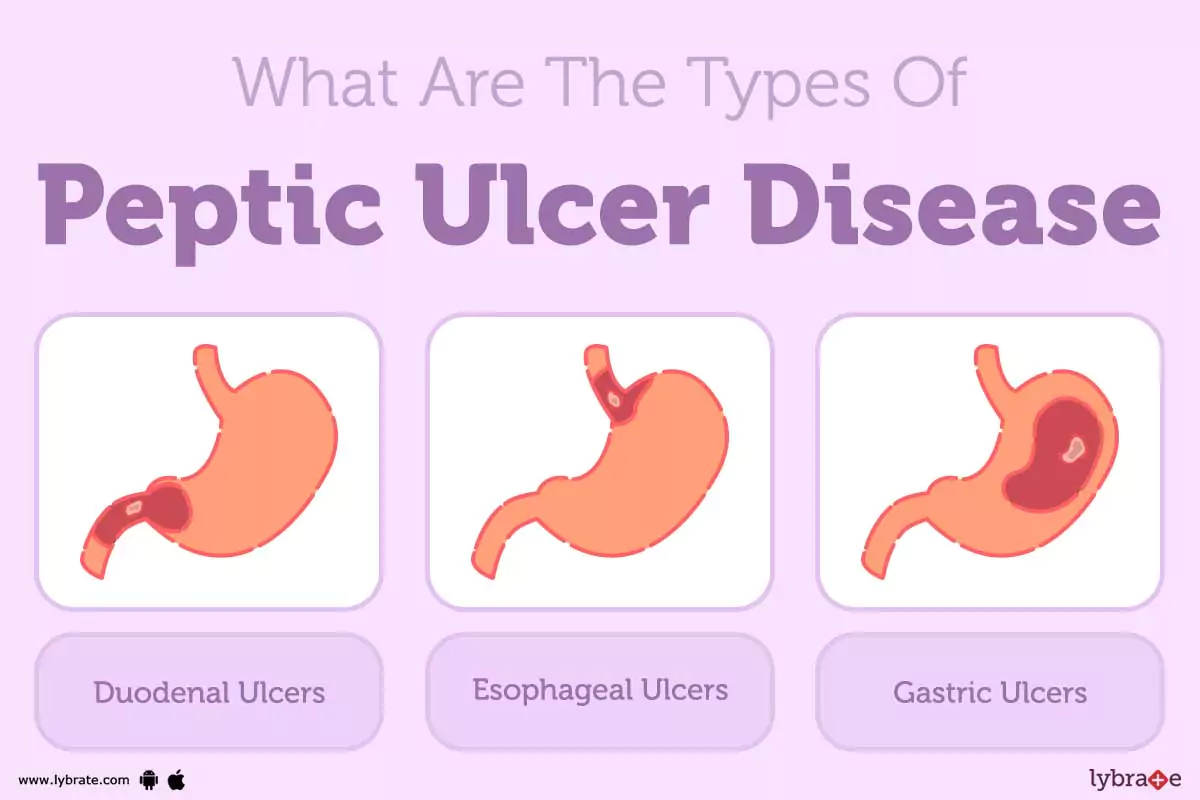 Peptic Ulcer Peptic Ulcer Stepwards Peptic Ulcer Peptic Ulcer Stepwards