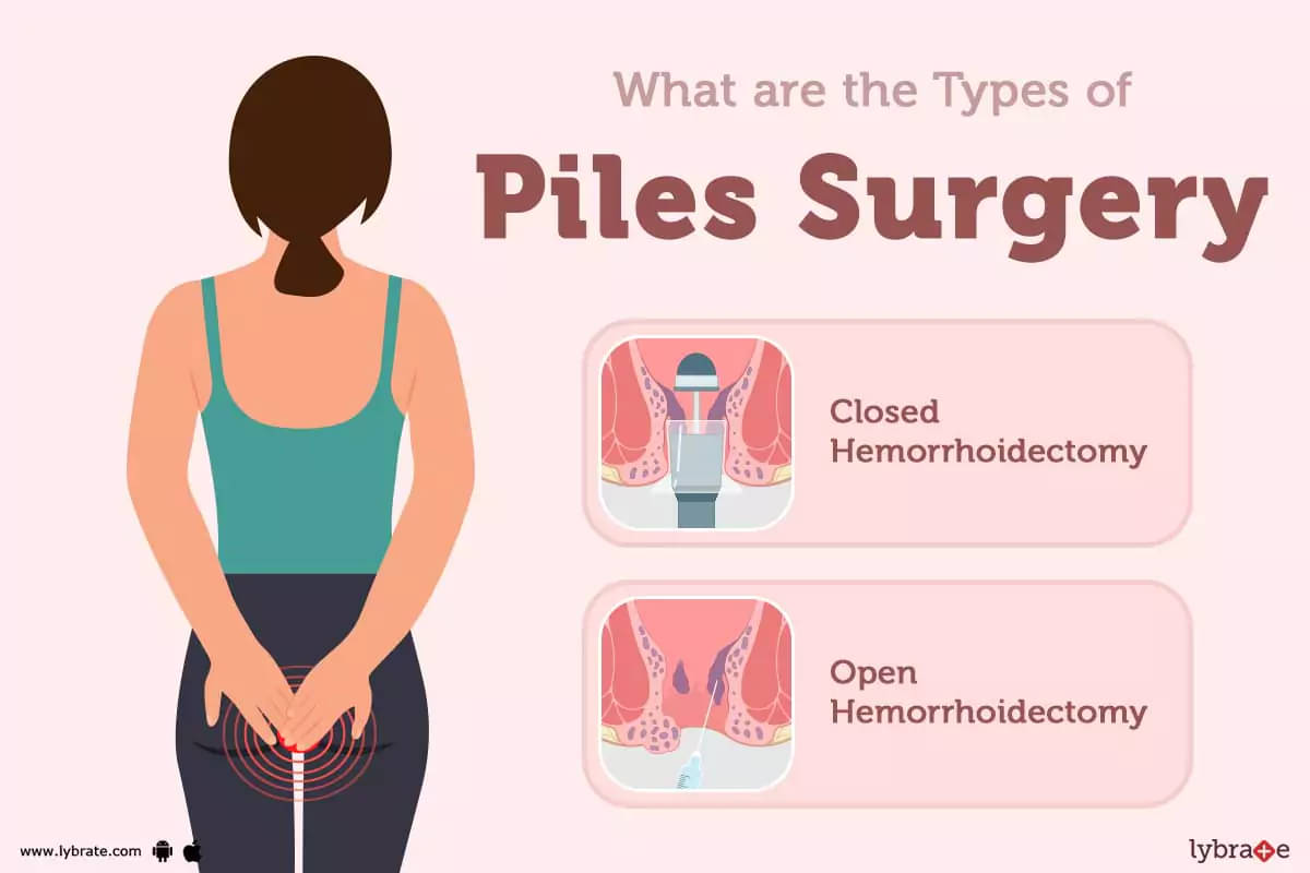 Surgery for Piles