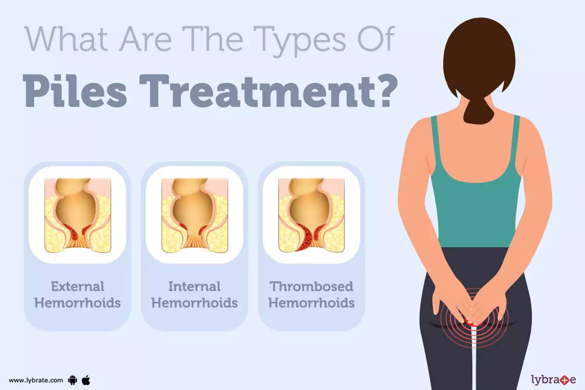 Piles (Haemorrhoids) Symptoms, Causes, Treatment And Cost image image