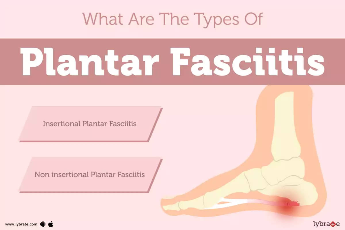 Symptoms, Causes and Risks of Plantar Fasciitis | How to Prevent It —  Feet&Feet