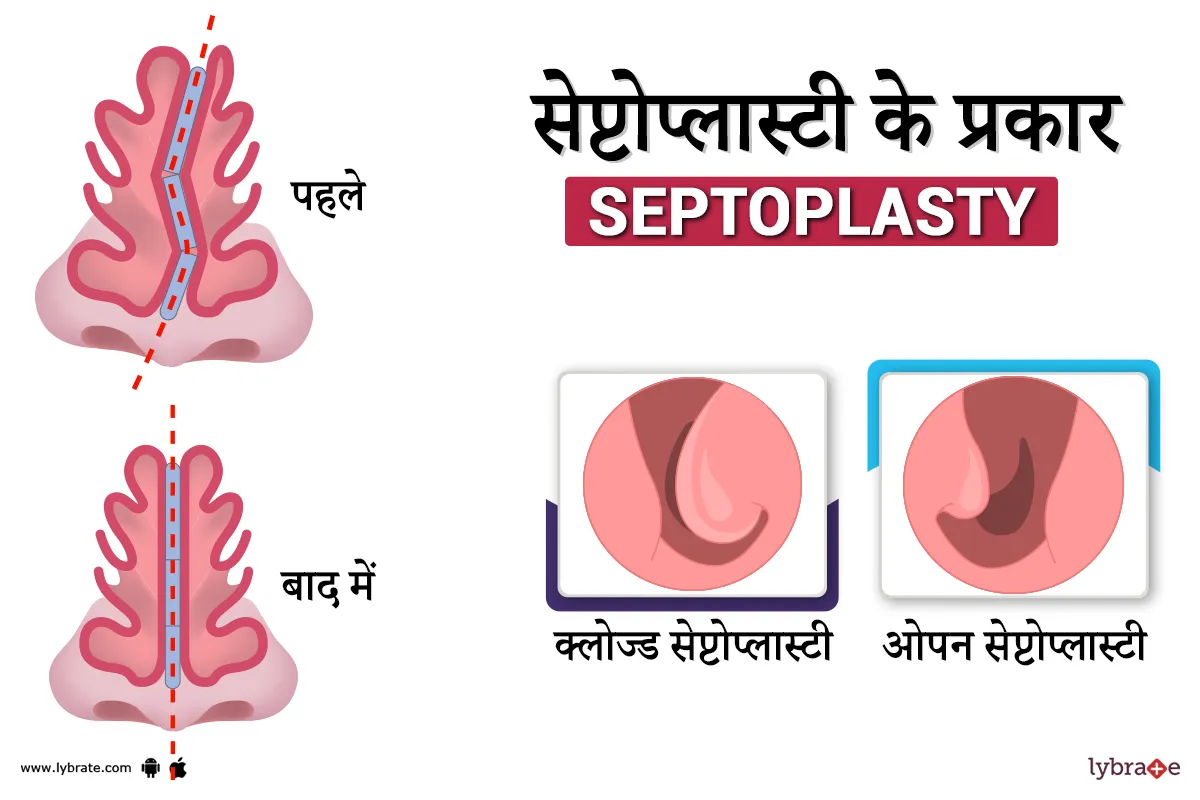 सेप्टोप्लास्टी के प्रकार (septoplasty Ke Prakaar)
