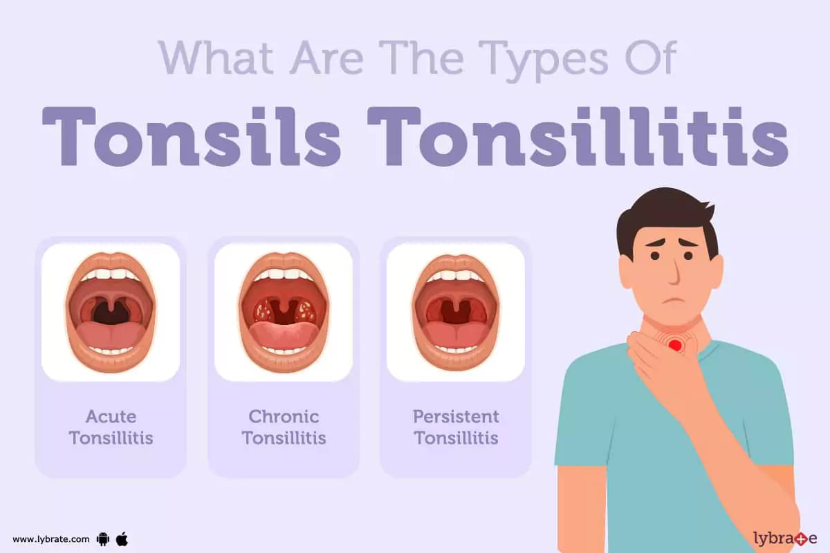 Tonsils/Tonsillitis: Causes, Symptoms, Diagnosis and Treatment