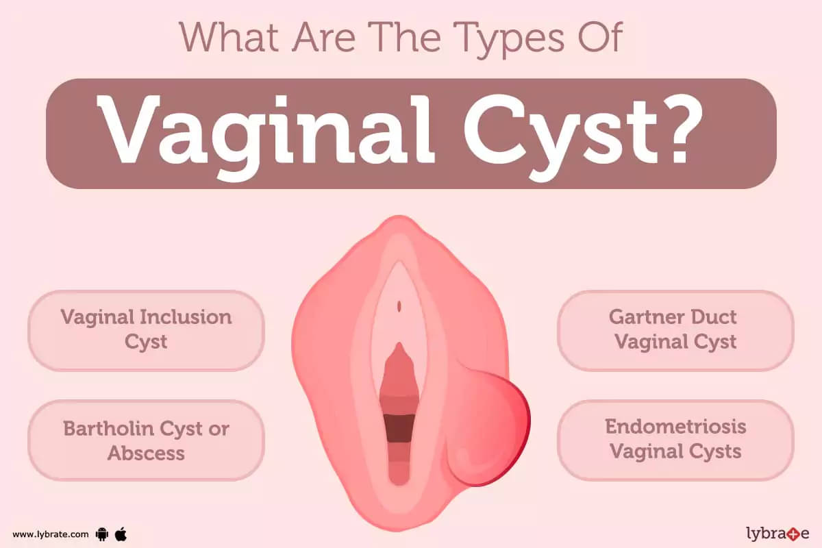 Vaginal Cyst Symptoms, Causes, Treatment and Cost