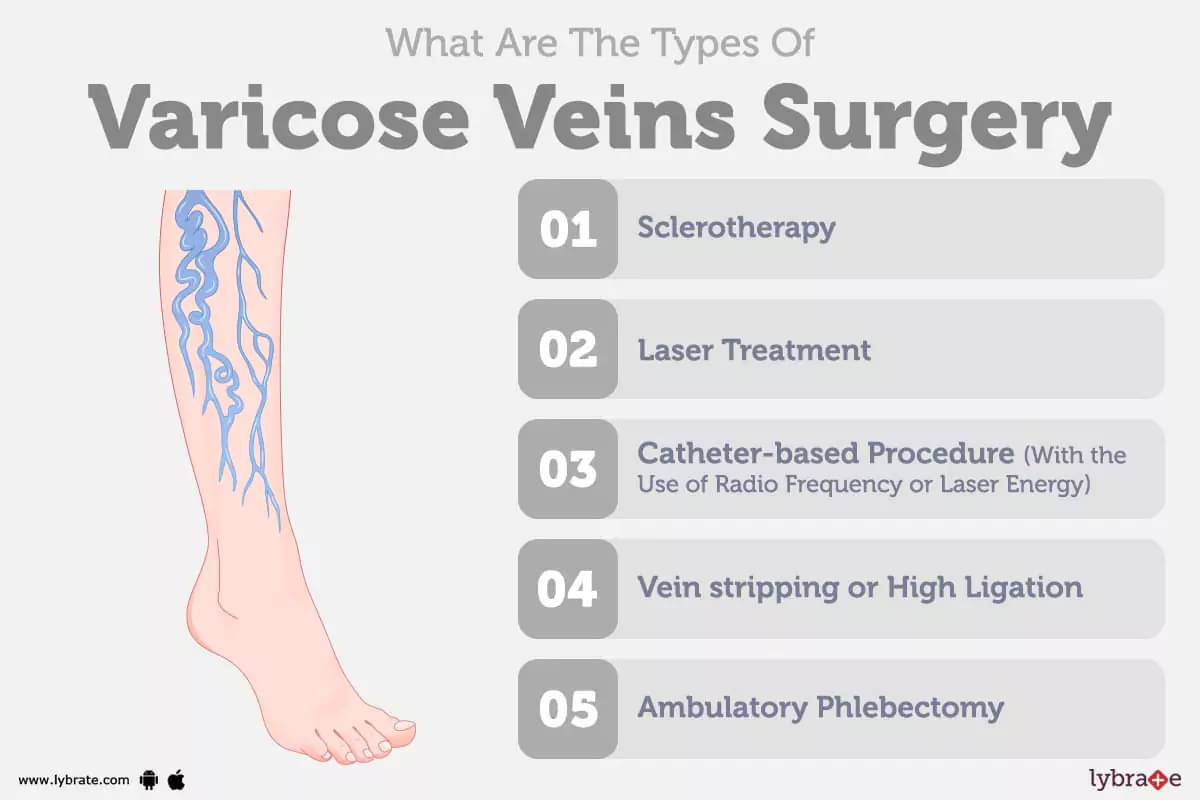 Varicose Veins Removal – Private Treatment