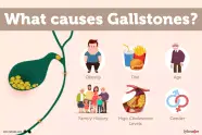 Gallstones Cholelithiasis Causes Symptoms Treatment 50 OFF