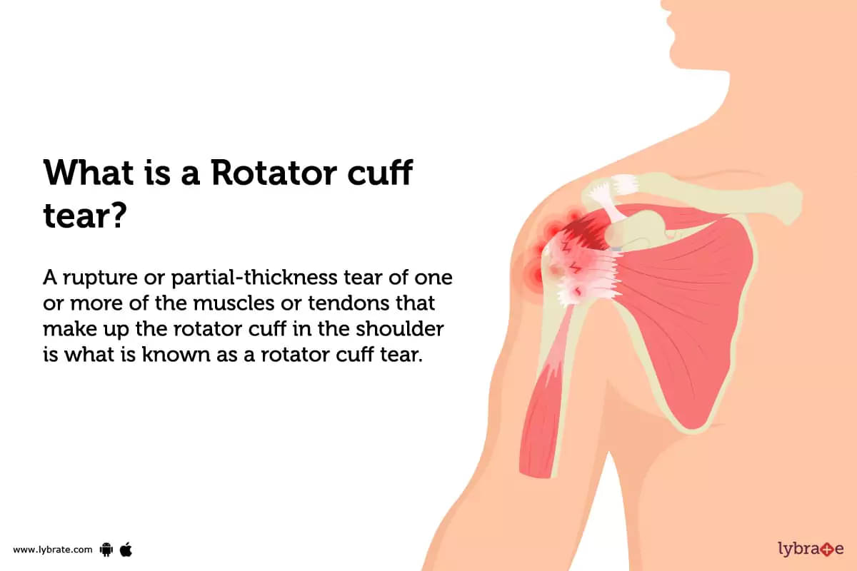 Rotator Cuff Tear: Causes, Symptoms And Treatment