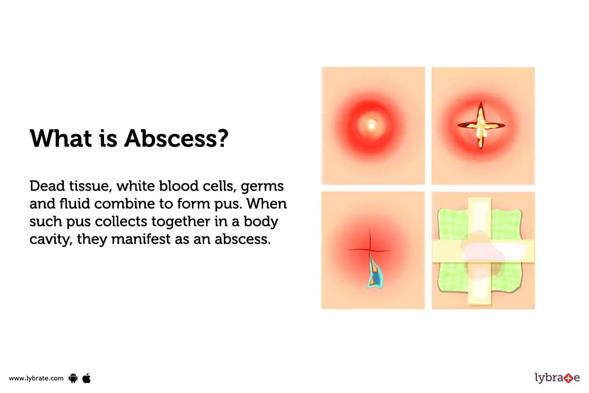Bartholin Abscess: Treatment, Procedure, Cost, Recovery, Side Effects And  More