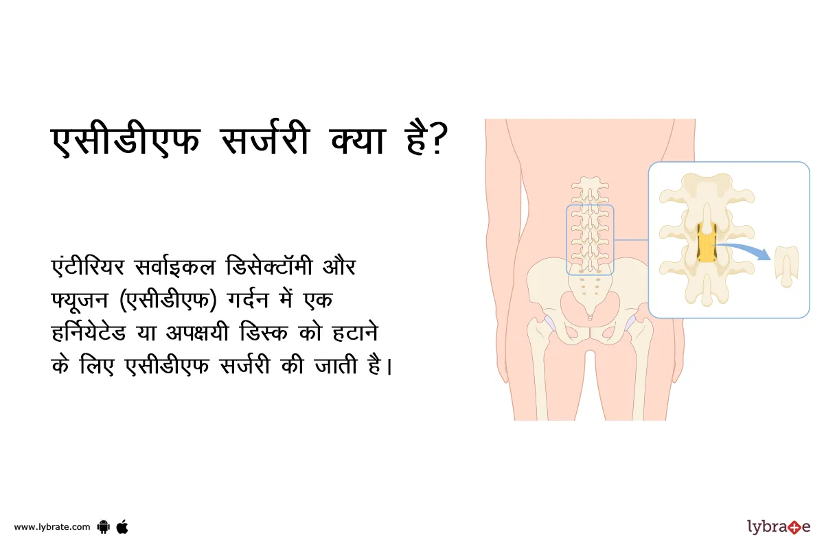 एसीडीएफ सर्जरी क्या है?