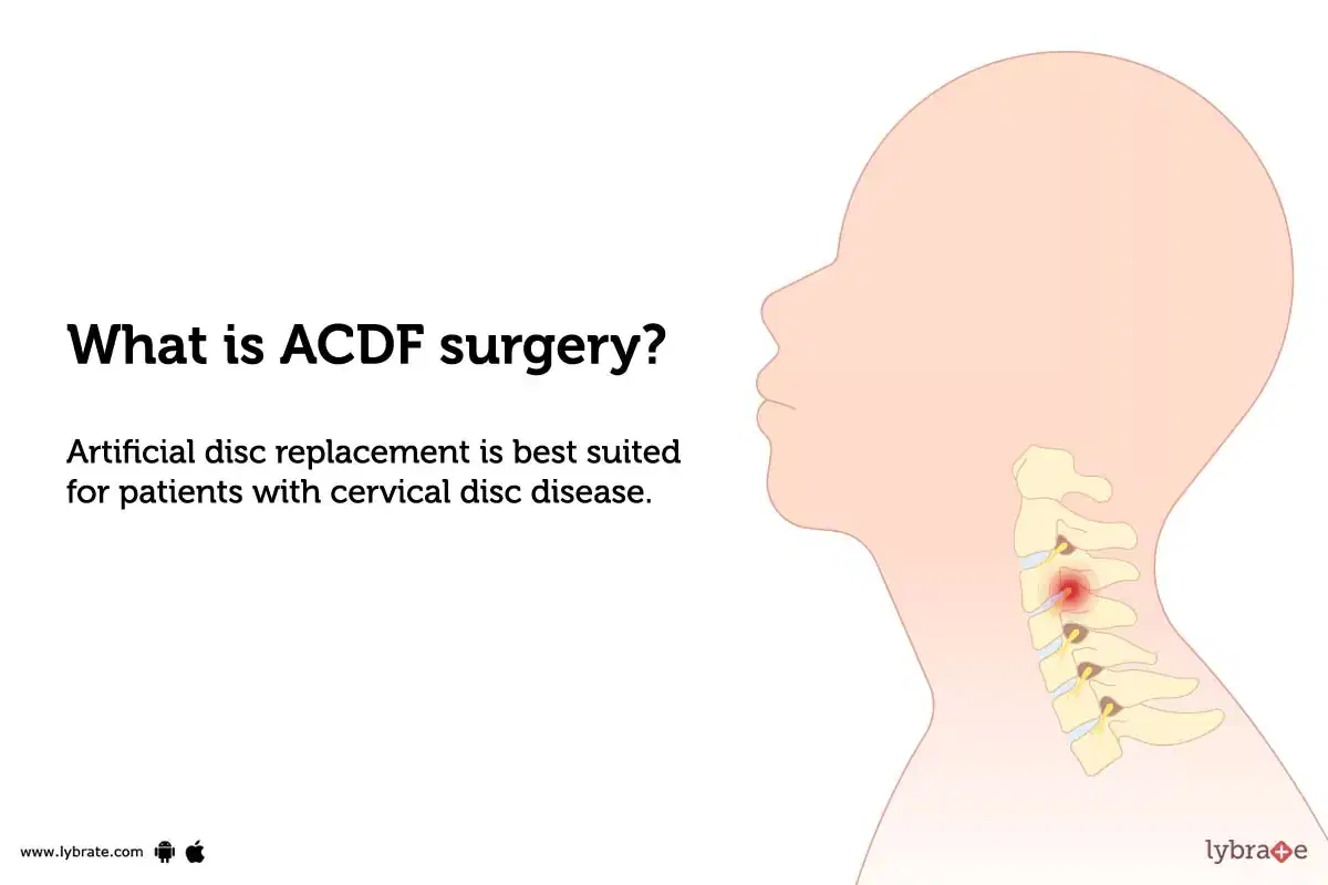 Cervical Spine Surgery Cost in India, Disc Replacement