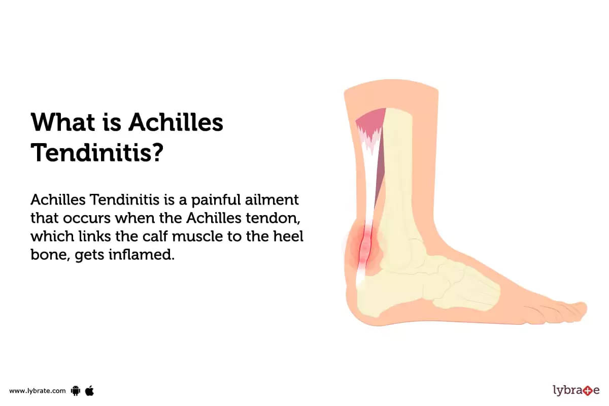 Achilles tendonitis - Comfort Feet Podiatry Group