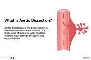 Aortic Dissection Explained Risk Factors Symptoms 58 OFF
