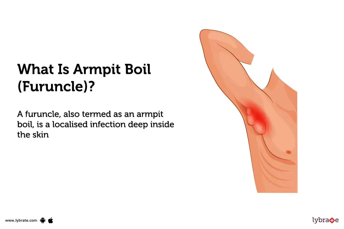 Armpit boil (furuncle): Causes, Symptoms, Treatment and Cost