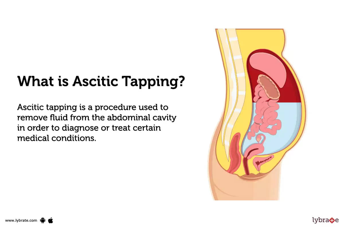 Ascitic Tapping: Causes, Symptoms, Treatment and Cost