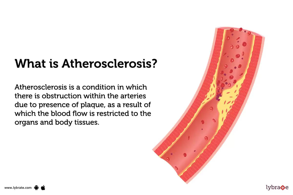 Atherosclerosis - What Is Atherosclerosis?