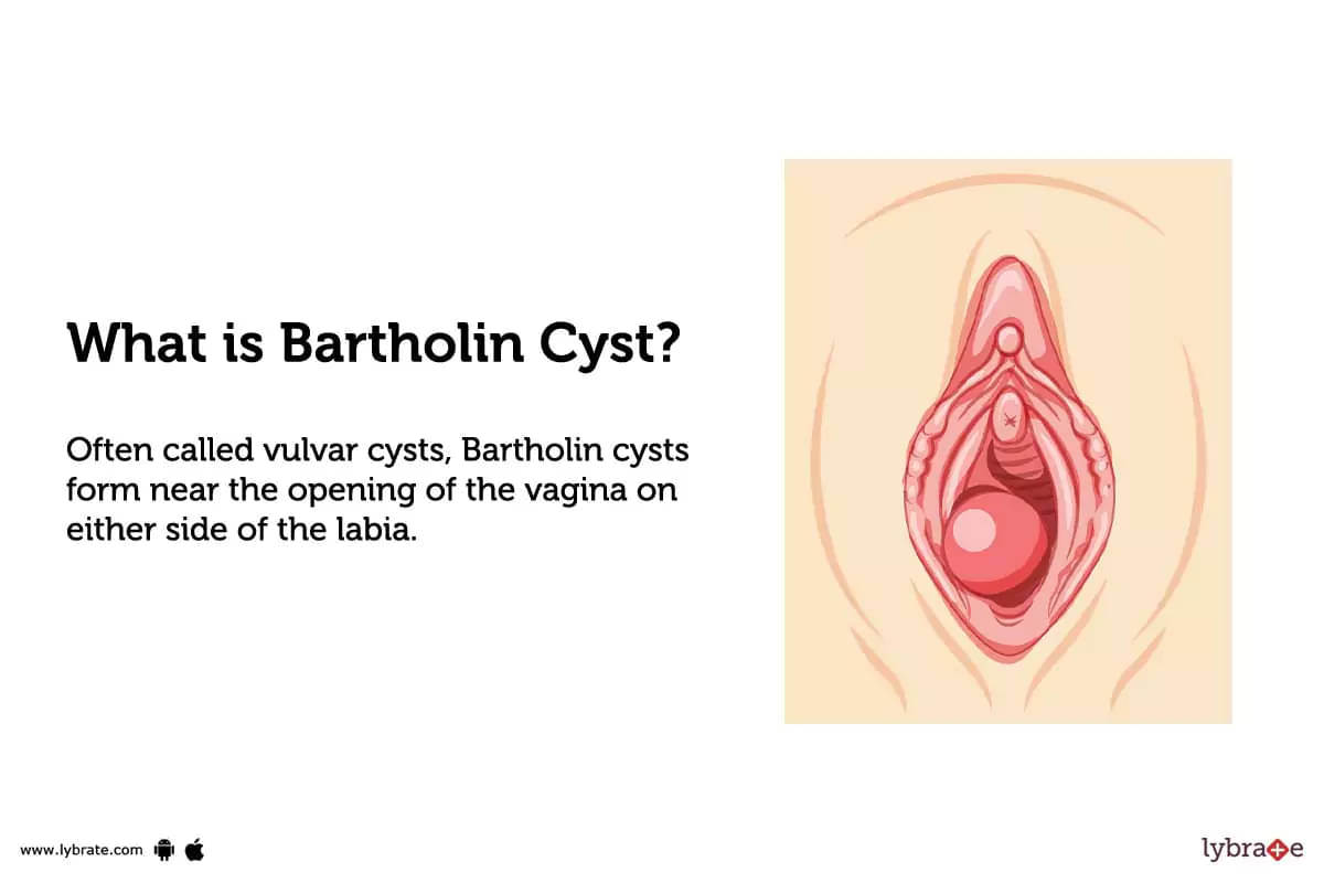Bartholin Abscess: Treatment, Procedure, Cost, Recovery, Side